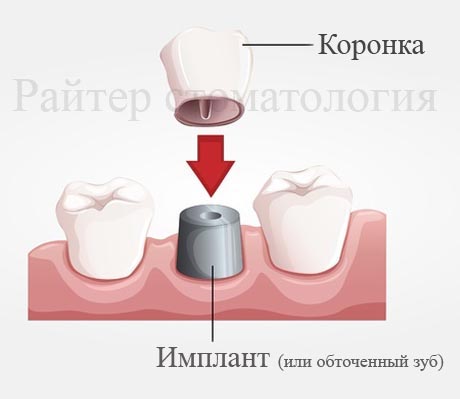 коронки на зубах