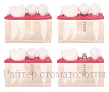 импланты straumann