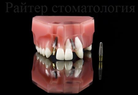 имплант straumann